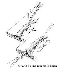 Resultado de imagen de gimolimpo